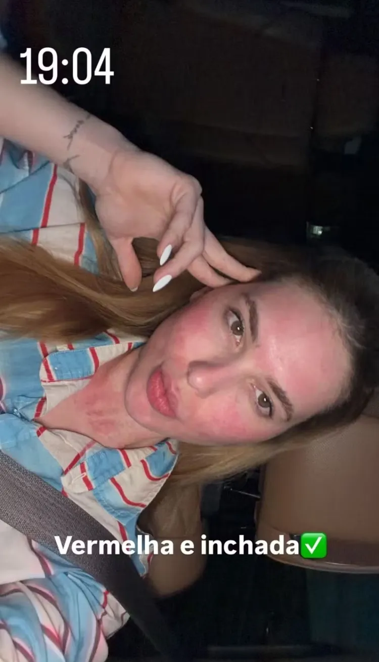 virginia-mostra-rosto-inchado-apos-procedimento-1768705609640_v2_750x1.jpg.webp